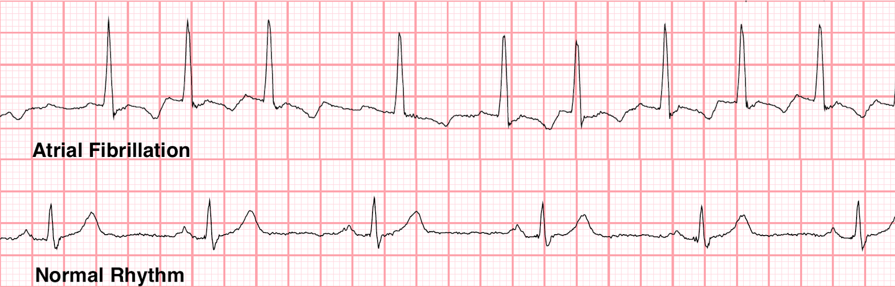 Rhythm strips of atrial fibrillation and normal sinus rhythm