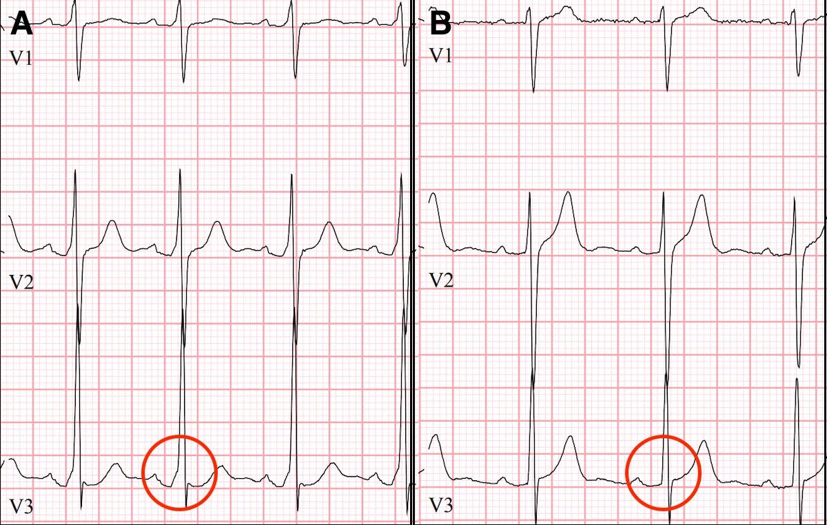 ECGs of WPW Before (left) and After (right) Catheter Ablation. In the left panel a slurring is seen called a 'delta wave'. After ablation (right) the 'delta wave' is gone