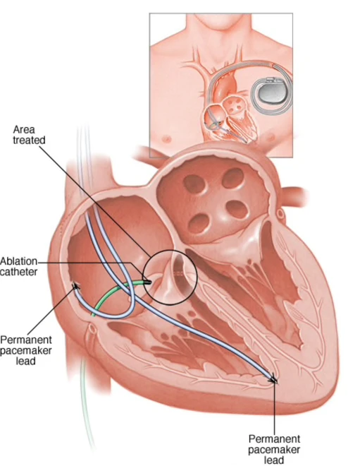 AV Node Ablation