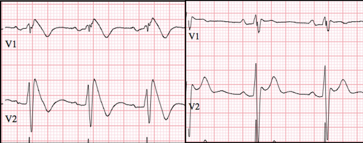 Brugada ECG Type 1 and 2 Image of Brugada Type I and Type II