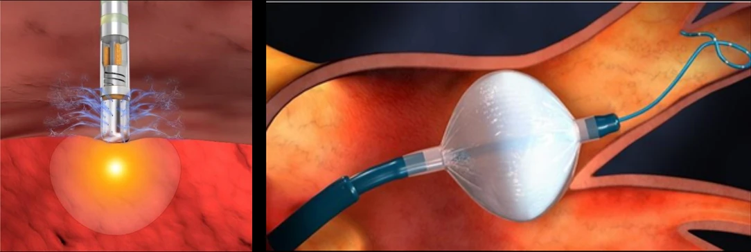 Radiofrequency Catheter on Left and Cryoballoon Catheter on Right