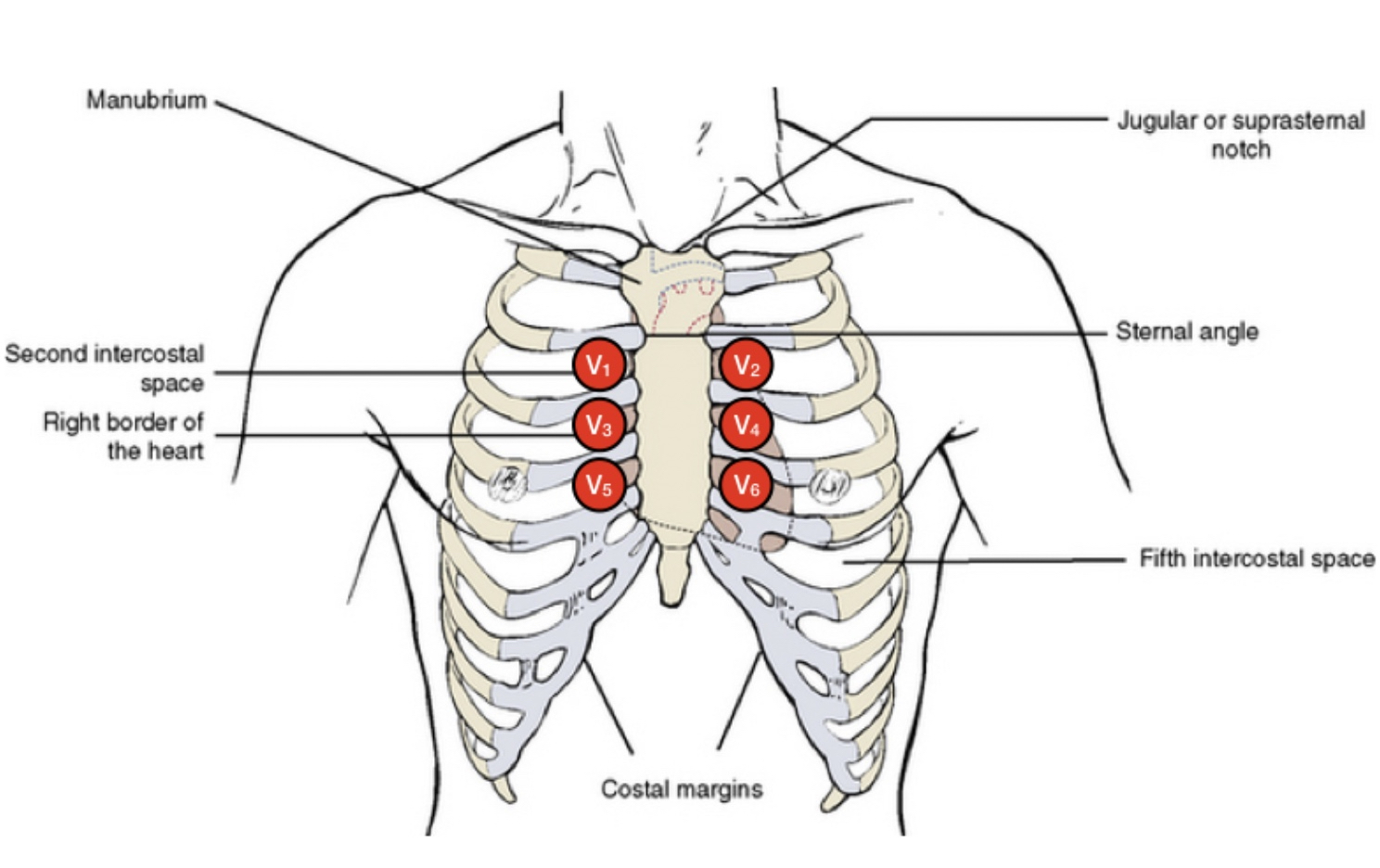 High Lead ECG Image showing the ECG positioning for a Brugada ECG