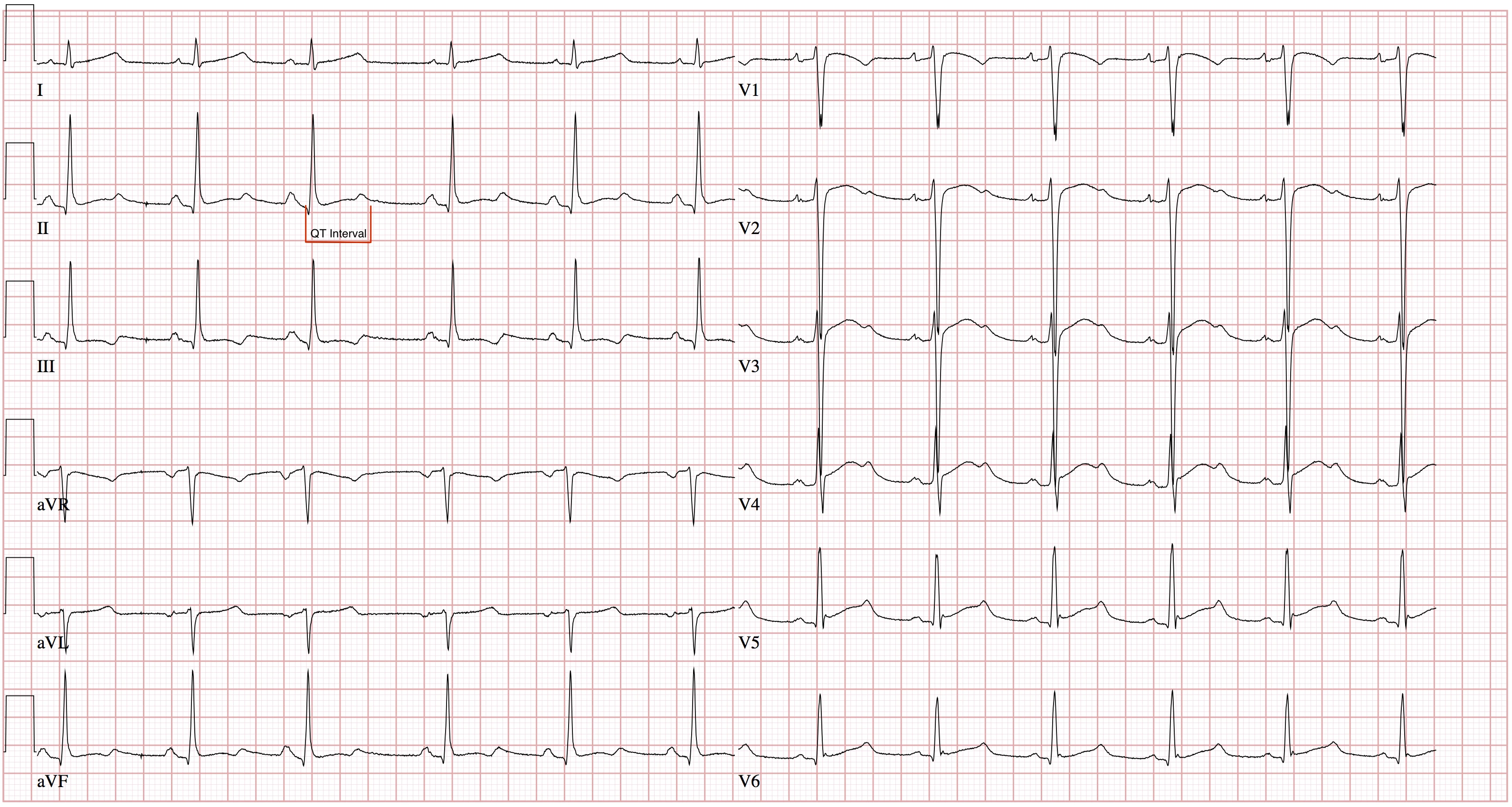 12 lead ECG of Long QT Syndrome