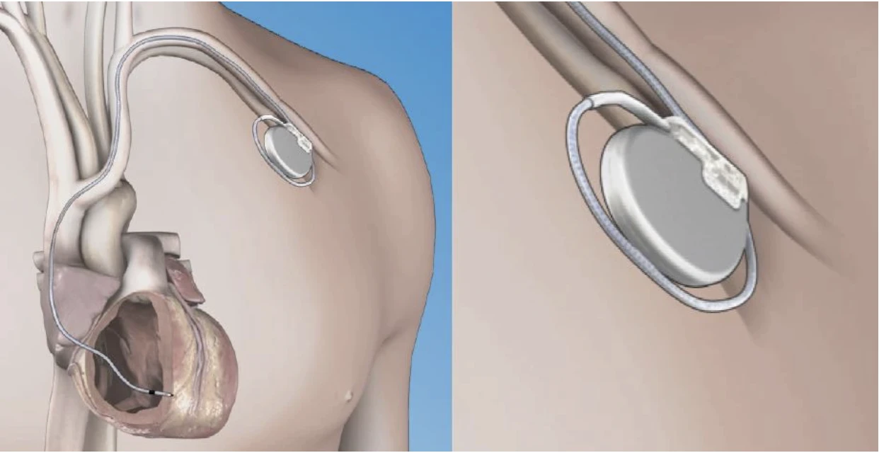 Single lead pacemaker