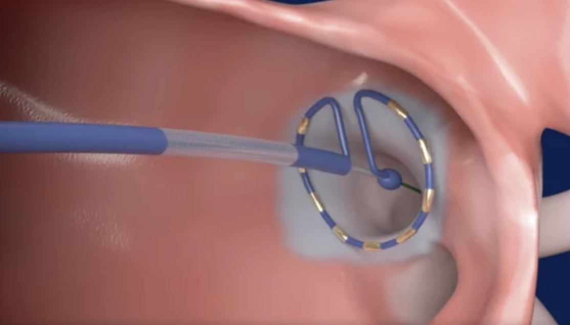 Pulse Field Ablation using the PulseSelect System